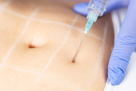 Fat-dissolving injections-procedure